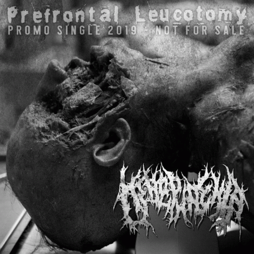 Prefrontal Leucotomy